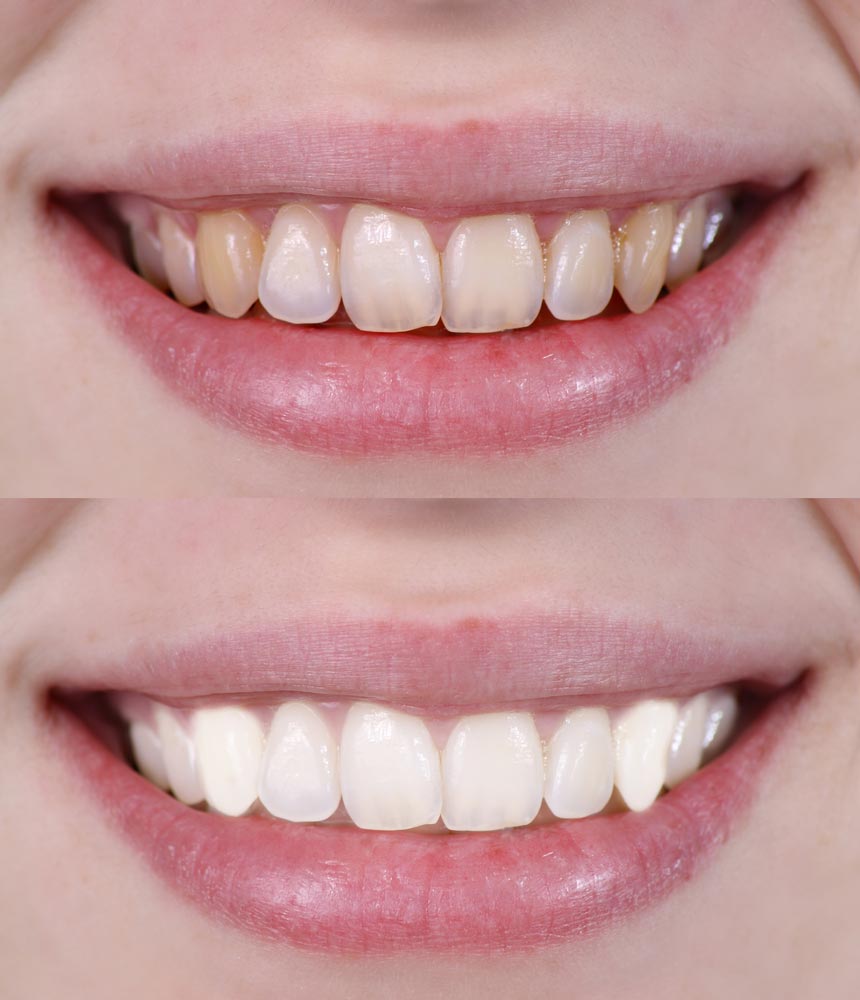Tooth Whitening Offer £149.99