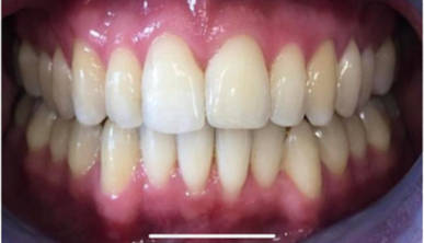Invisalign After 2