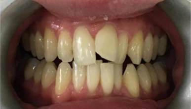 Invisalign Before 2